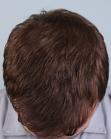 After Hair Transplant&nbsp;Front
